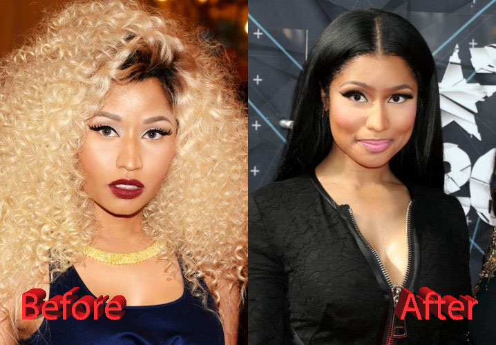 Nicki Minaj Plastic Surgery Fact Or Not