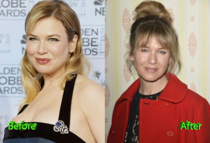 Renee Zellweger Before And After Cosmetic Surgery Plastic Surgery