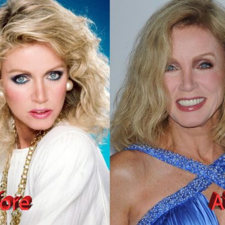 Donna Mills After Facelift - Plastic Surgery Mistakes