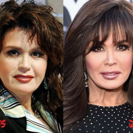 Marie Osmond Plastic Surgery: is it really just Botox? - Plastic ...