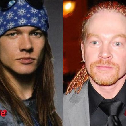 Axl Rose Before and After Cosmetic Surgery - Plastic Surgery Mistakes