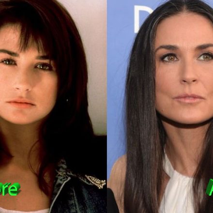 Demi Moore Plastic Surgery Gone Too Far