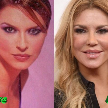 Brandi Glanville Plastic Surgery: A Botox Overdose