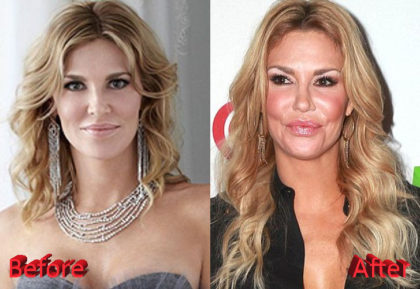 Brandi Glanville Plastic Surgery: A Botox Overdose