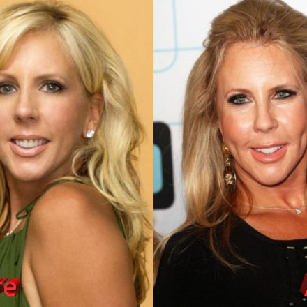 Vicki Gunvalson Plastic Surgery: Where Is The End Of It?