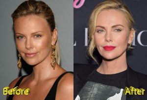 Charlize Theron Before And After Cosmetic Surgery Plastic Surgery
